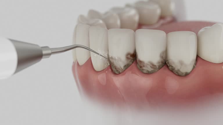 Trusted Dental Crowns And Bridges service in Mercer Island, WA - Dentist Open Now